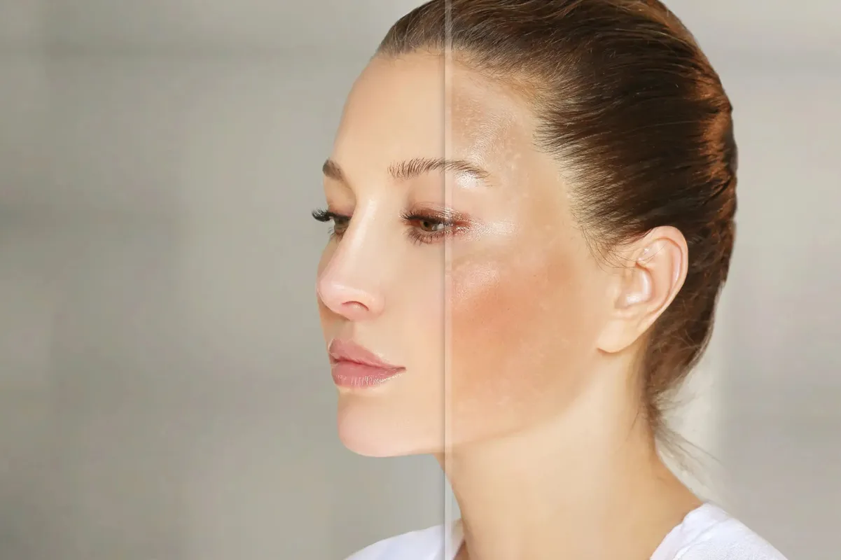 Woman with melasma and sun-induced dark spots on her cheeks, a common concern treated at Touch and Glow Med Spa in Glendale, Arizona.