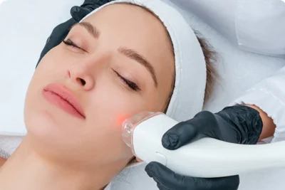 Comparison of CO2 laser resurfacing and Vivace Ultra RF microneedling in Glendale Arizona